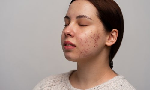 Acne ,Pimples & Pigmentation Treatments